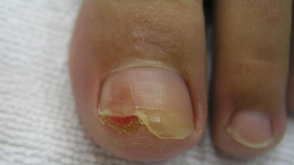 Μύκητες στα νύχια: Τρικ υγείας για φυσική αντιμετωπίση