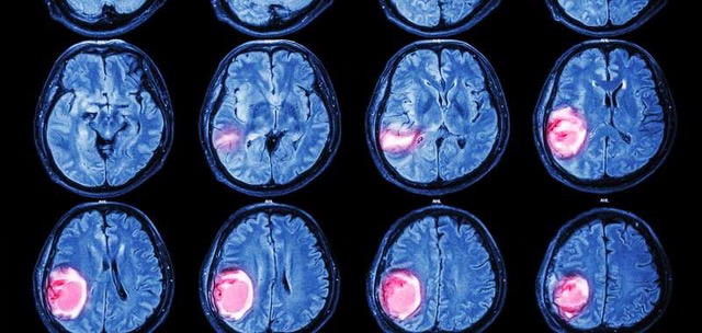 Οι όγκοι εγκεφάλου δείχνουν καποια συμπτωματα